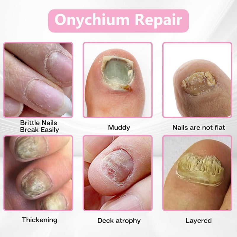 Fungal Nail Patches 60 Pcs – Extra Strength Hydrogel Treatment for Toenail Fungus, Upgraded Overnight Repair Nail Patches, 8-Hour Nighttime Nail Fungus Patches for Nail Fungus Treatment - BeesActive Australia