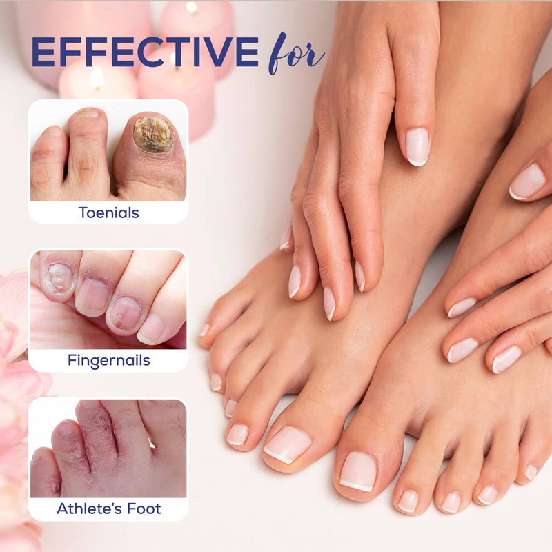 Toenail Fungus Treatment Extra Strength: 25% Undecylenic Acid Toe & Fingernail Fungus Renewal - Nail Fungus Treatment Kit with Brush & File - For Ingrown Nails & Discoloration 1 Fl Oz (Pack of 1)