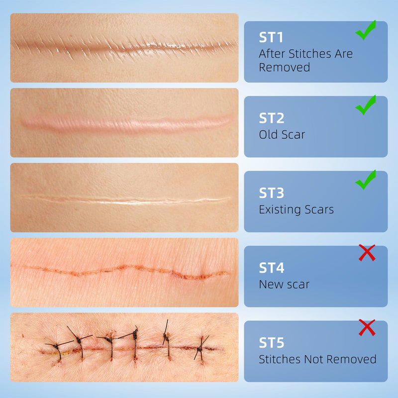 Silicone Scar Gel for Old and New Scars, Stretch Marks & Acne Scar Removal, Advanced Silicone Scar Cream for Surgical, Burn, Keloid, Injury & Acne Scars, Fast Absorbing Gel, 1.76 oz (50ml)