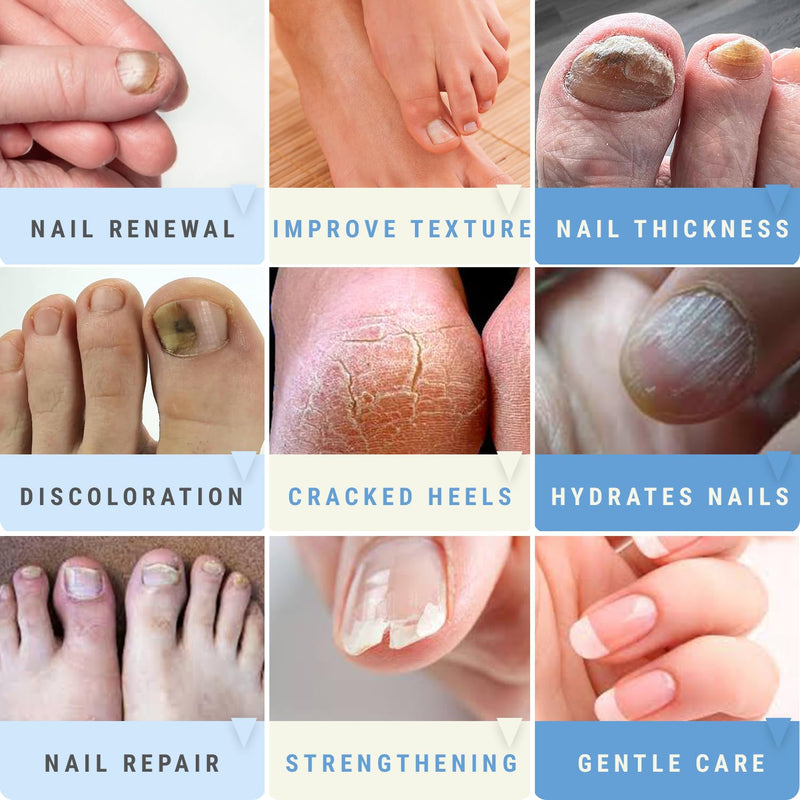 Urea 50% Nail Gel - Softens Cracked Heel Calluses & Thick Toenails - Repairs Damaged, Yellow, Discolored Nails – Highly Effective & Quick-Dry Fingernails & Toenail Treatment Blue Urea 50 - BeesActive Australia