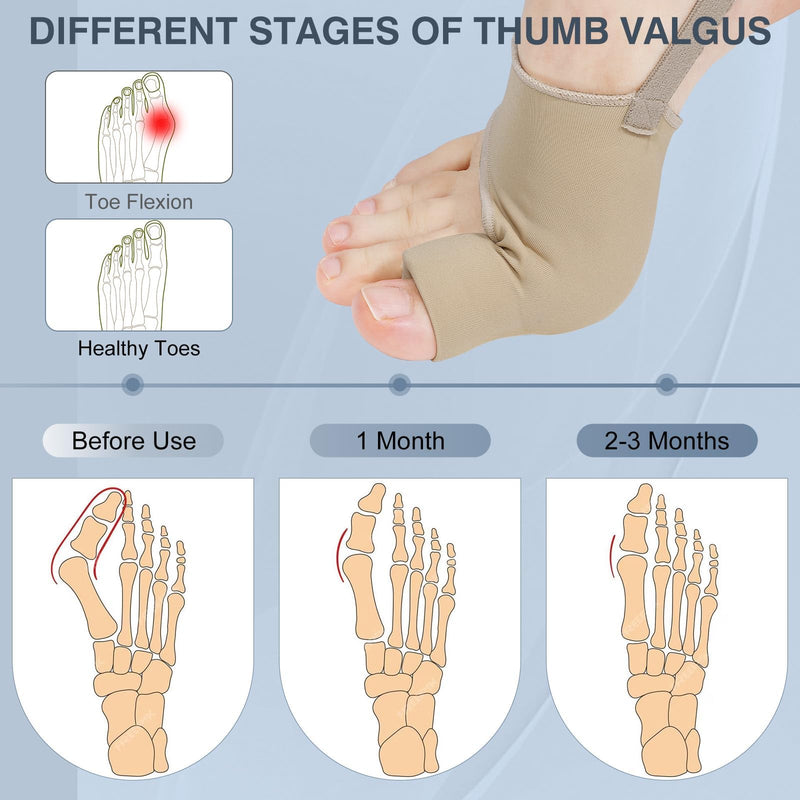 KTSAY 2PCS Bunion Corrector for Women & Men, Big Toe Straightener with Splint & Pads, Comfortable & Breathable for Day/Night Support, Hallux Valgus Pain Relief Non-Slip Socks (1, Beige) 1 - BeesActive Australia