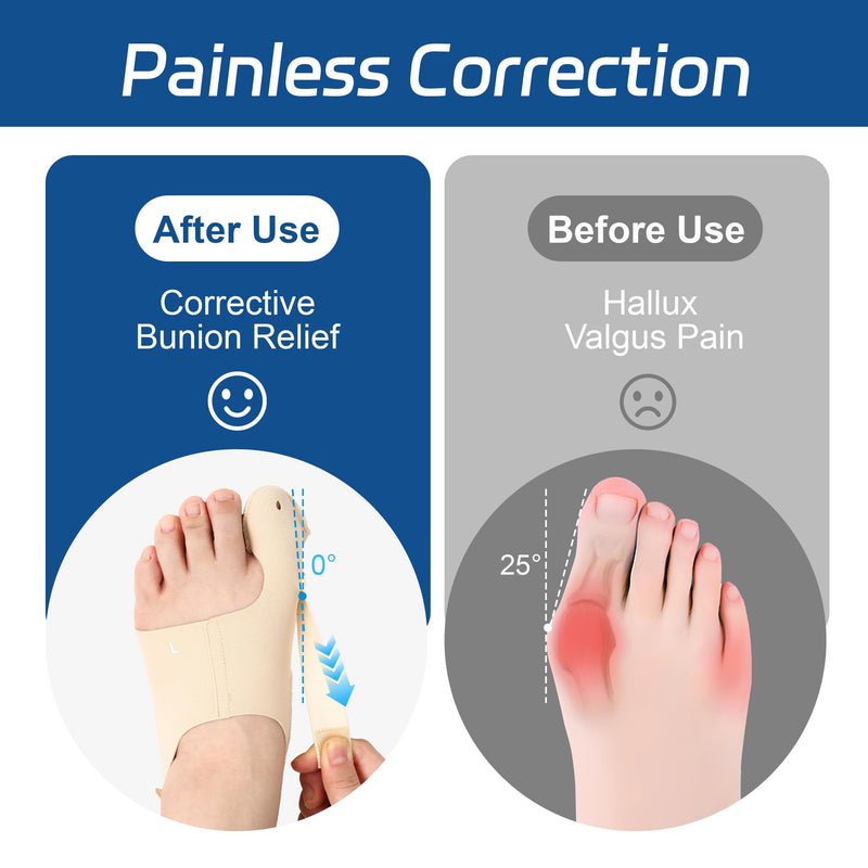 RANDY SUN Toe Corrector for Bunion Relief – Lightweight Hallux Valgus Straightener, Adjustable Toe Separators & Spacers for Men Women, Thin Design for Daily Use with Shoes, Medium Beige - BeesActive Australia