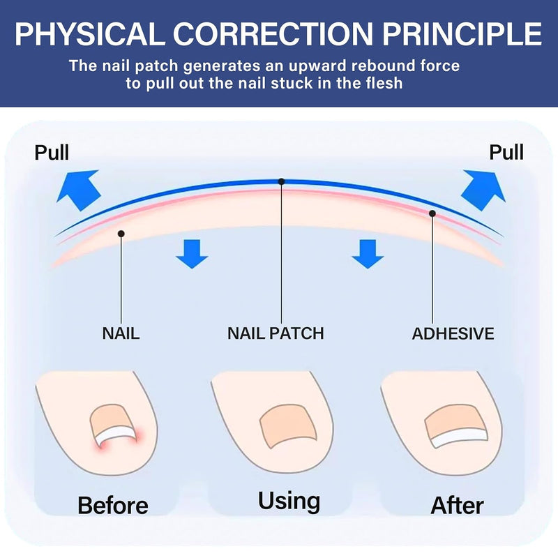 Ingrown Toenail Treatment, Toenail Correction Strips for Curved or Ingrown Nails, Quick Relief, Nail Correction, 5 Different Sizes 1 Count (Pack of 1)