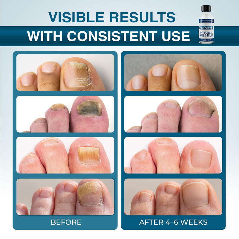 FUNGINIX Toenail Fungus Treatment Extra Strength - Antifungal Nail Treatment With 10% Undecylenic Acid & Tea Tree Oil - Includes Natural Oils & Botanicals - Made in USA (Packaging Does Vary) 1 Fl Oz (Pack of 1)