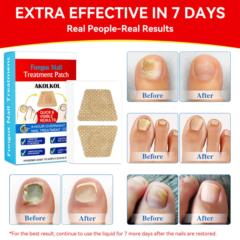 Toenail Fungus Treatment Extra Strength, 60 PCS Nail Repair Patches for Overnight, 8-Hour Fungal Nail Patches Renewal for Men and Women, Nail Fungus Treatments Patches Non-Falling Off Design White (60 pcs)