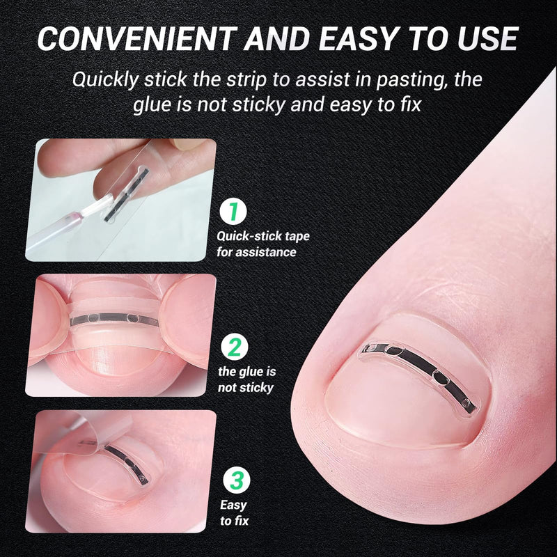 Titanium Alloy Ingrown Toenail Corrector & Pain Relief Aid - Specially Designed Ingrown Toenail & Corrector Removal Kit for Curved Nail Repair and Removal (0.59/0.67in) 0.59/0.67in