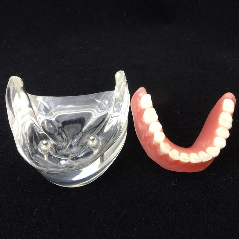 Dental Model Overdenture Inferior 2 Implants Demo for Studing and Teaching
