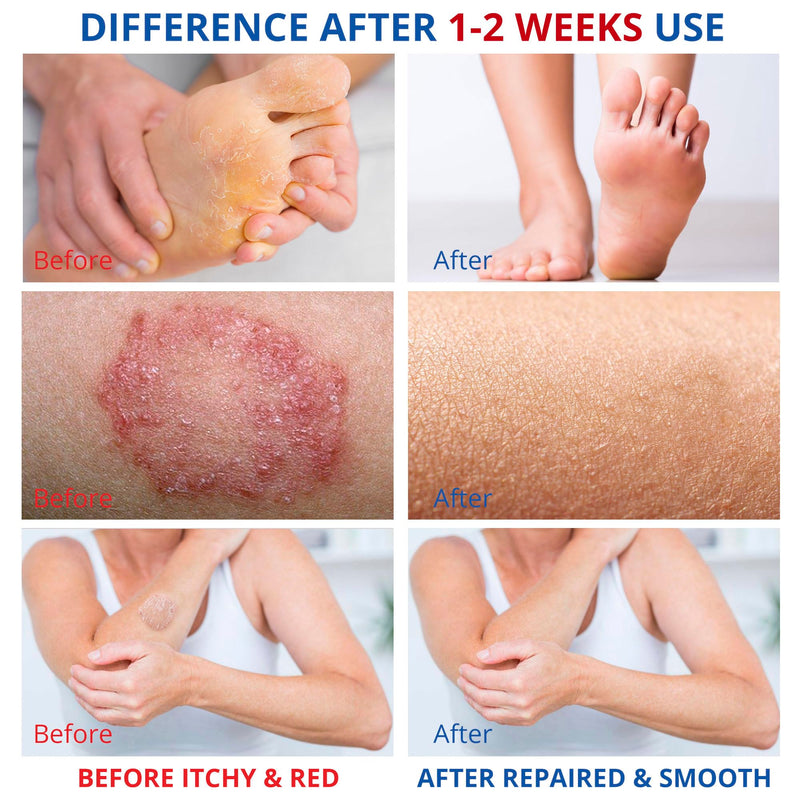 Athletes Foot Treatment-Antifungal Cream-Treatment for Jock Itch,Ringworm, Psoriasis,Eczema,Rash-Anti Fungal Skin Cream for Itchy Skin-Foot Balm with Natural Ingredients-50g 1.7 Fl Oz (Pack of 1)