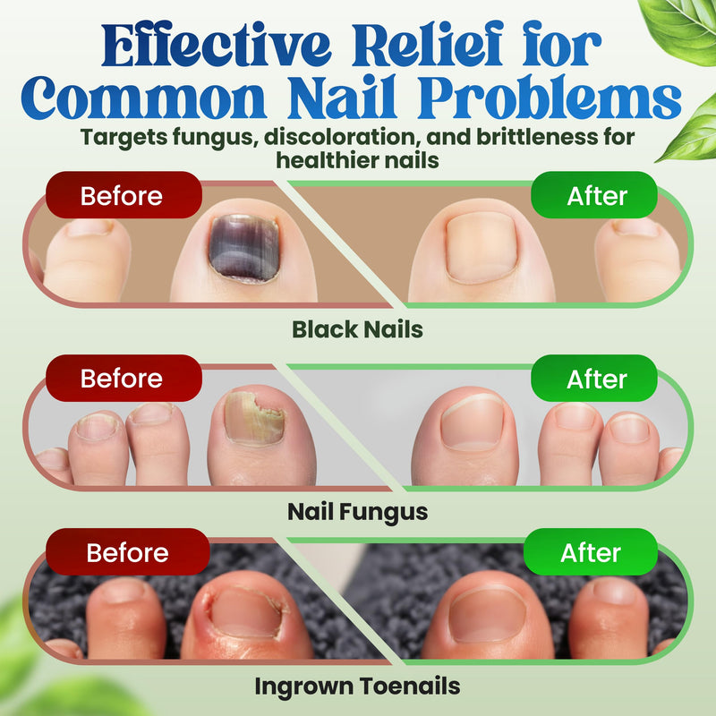 Premium Fungal Nail File Patches Toe Foot Repair Care Extra Fungus Strength 21 Pcs Nighttime Damaged Treatment Toenail ingrown Nails Strengthen 8 Hour Safe Sensitive gift for Women Men .(21 Count) 21 Count - BeesActive Australia