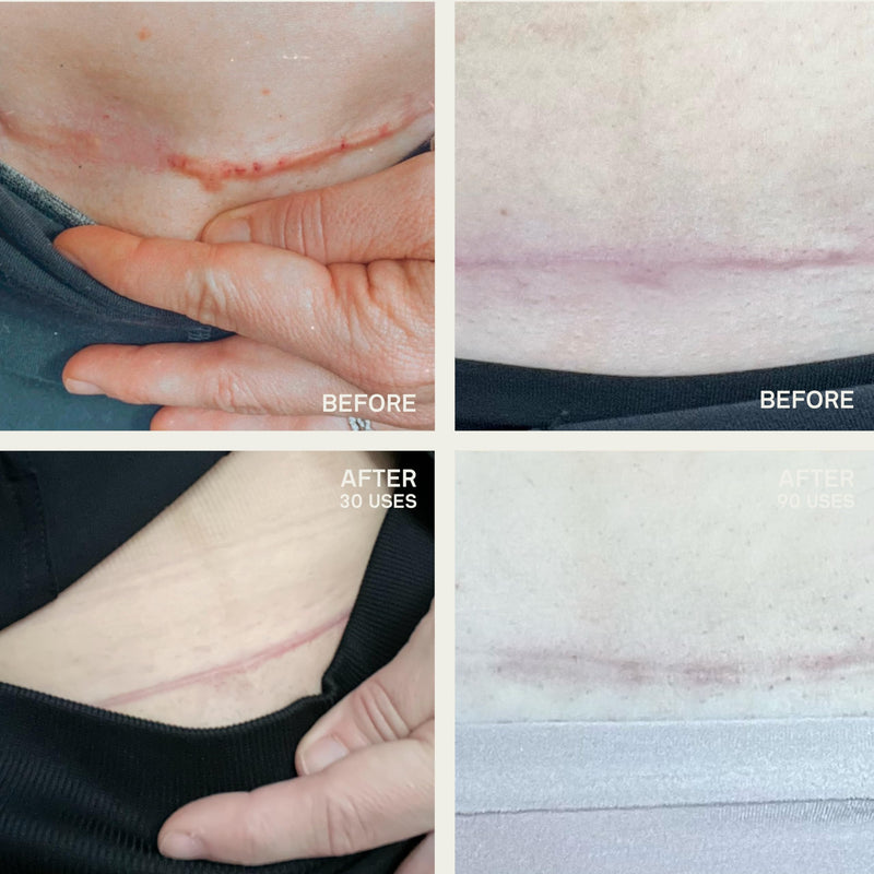 Dermaclara C-Section Scar Patch - Pregnancy Stretch Mark Prevention & Removal, C Section Cover Up Belly Scar Sheet, Maternity Skincare, Mom to Be Silicone Gel Pad, Reusable up to 30 Times - 1 Patch