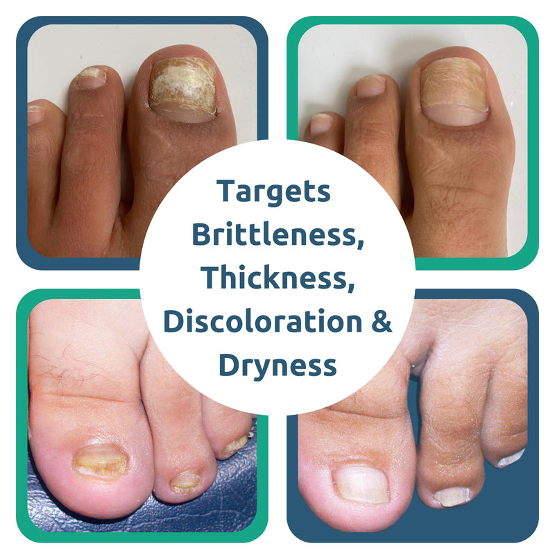 Nail Renewal Gel, Discoloration, Thickened Nails, Cracking, Brittle Nails, Fast 2-Day Results - BeesActive Australia