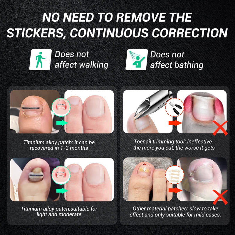 Titanium Alloy Ingrown Toenail Corrector & Pain Relief Aid - Specially Designed Ingrown Toenail & Corrector Removal Kit for Curved Nail Repair and Removal (0.59/0.67in) 0.59/0.67in