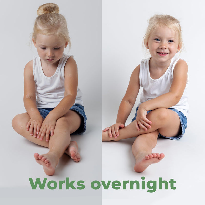 Bug Bite Patches (60 Pack) Mosquito Bite Itch Relief for Kids (Hydrocolloid, Aloe Vera & Witch Hazel, Mosquito Patches for Skin, Bug Bite Itch Relief Stickers for Insect Bites (Skin Friendly) Bug Bite Patch