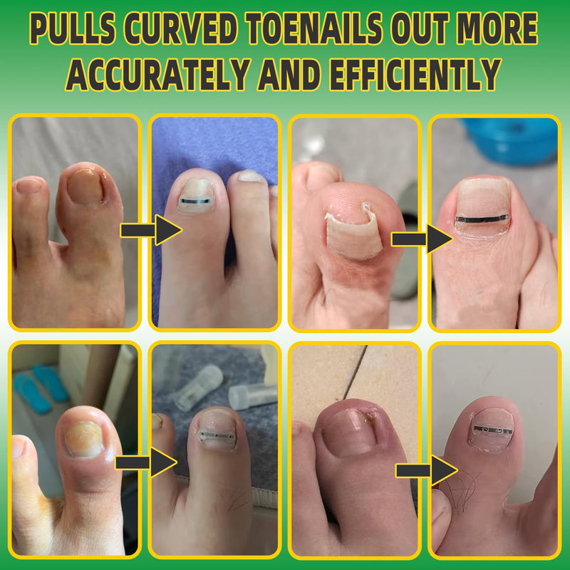 Ingrown Toenail Treatment Kit, Titanium Alloy Ingrown Toenail Removal Kit, Nails Corrector Tool & Remover Strips - Ingrown Toe Nail Quick Relief 10 Count (Pack of 1)