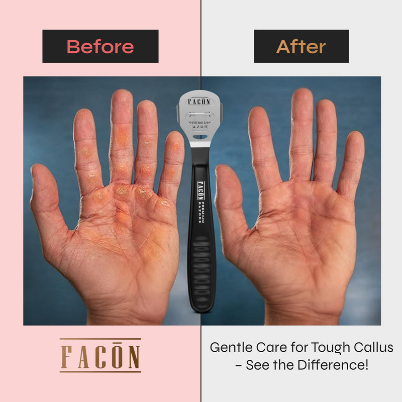 Fac√≥n Professional Callus Shaver Remover with 50 Blades, Pedicure Razor for Feet & Hands, Foot Razor for Callus Removal, Callus Blade Remover, Corn Shaver, Surgical Grade Premium Stainless Steel Tool Black