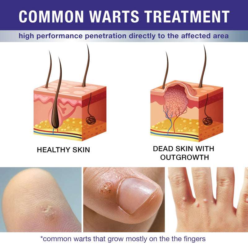 DrLuke Wart Corn Remover for Toes Feet: Fast Acting Plantar Wart Common Wart Flat Wart Corn Removal - Salicylic Acid Wart Corn Removal for Feet Toes Finger and Hand - BeesActive Australia