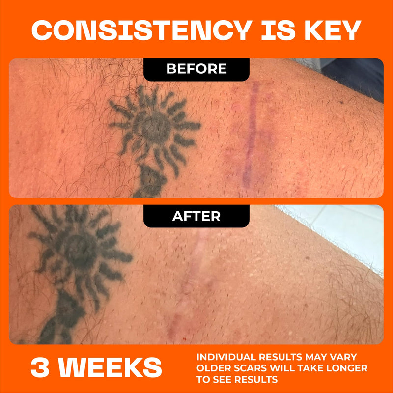 Motivo Scar Serum - Silicone Scar Treatment for New Surgical Scars, Burns, Procedures & Acne Scars - Helps Itching and Irritation for Kids & Adults - Helps Flatten & Soften Scars (10ml) - BeesActive Australia