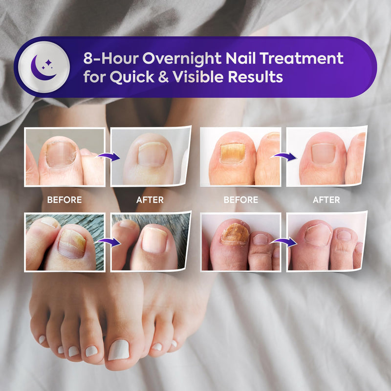 Natural Vine Fungal Nail Patches: Max Strength Formula for Toenail and Fingernails - 8-Hour Nighttime Renewal with 1% Tolnaftate - Toenail Fungus Treatment Extra Strength 32 Patches 32 Count (Pack of 1)