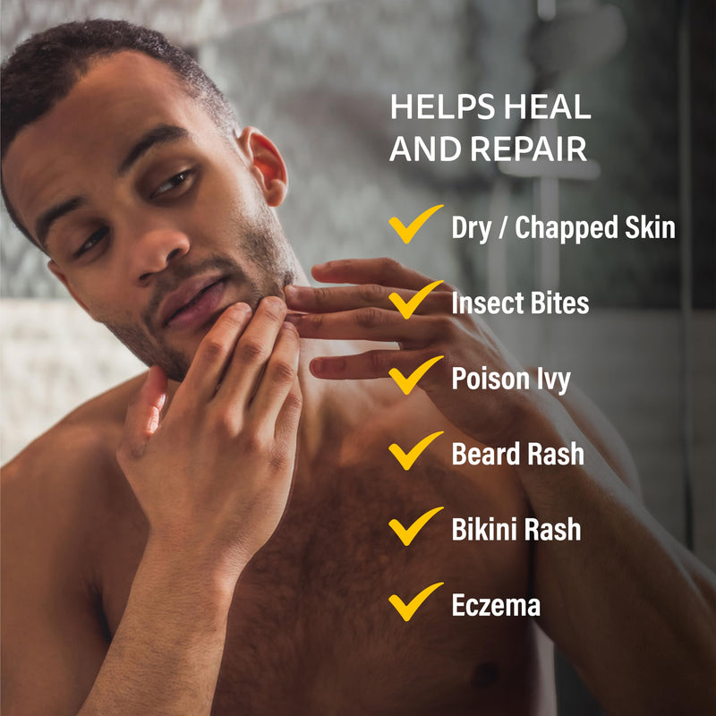 A+D Medicated Rash Ointment 1.5 oz‚Äì Relieves Rash & Skin Irritated Skin from Poison Ivy, Eczema, Beard Rash, Bikini Rash, Dry Skin, Chapped Skin, bug bites. Made with Colloidal Oatmeal
