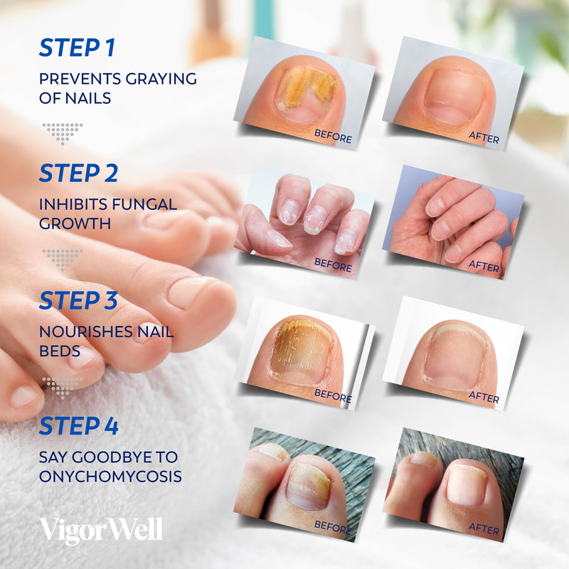 Toenail Fungus Treatment Extra Strength - (Medium) 32 Nighttime Hydrogel Patches for Overnight Toenail Repair - Visible Results in 8 Hours - Fungal Nail Patches for Toenail Fungus Relief 32 Count (Pack of 1)