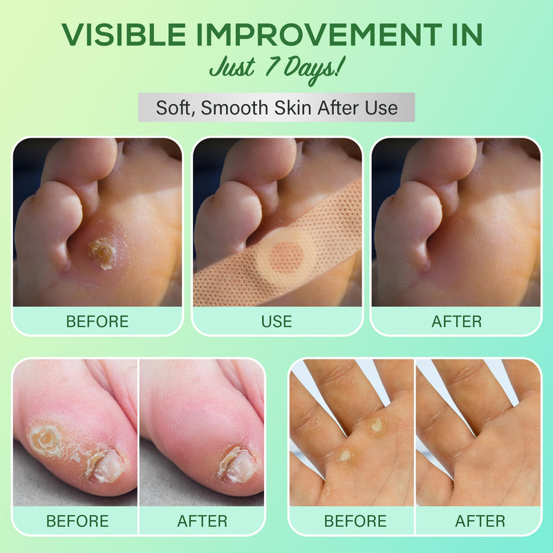 SupreH Corn Removers for Toes Feet Bandages: Corn Cushions and Small Callus Removal with 40% Salicylic Acid Long Adhesive - for Adult Seniors Nurses Hikers Athletes Men Women Pads 22 24 Pads - BeesActive Australia