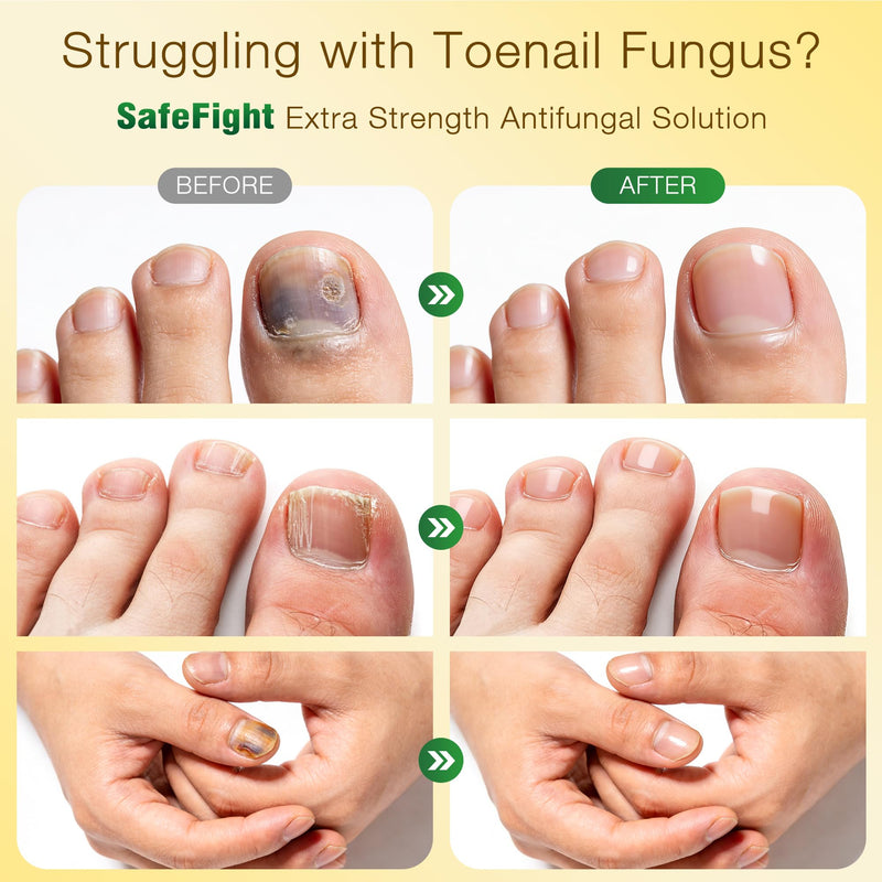 Toenail Fungus Treatment with 25% Undecylenic Acid & Tolnaftate - SafeFight Nail Repair Solution for Fungi Nail, Toenail Fungus Treatment Extra Strength Nail Repair for Fungi Nail 30ml - BeesActive Australia