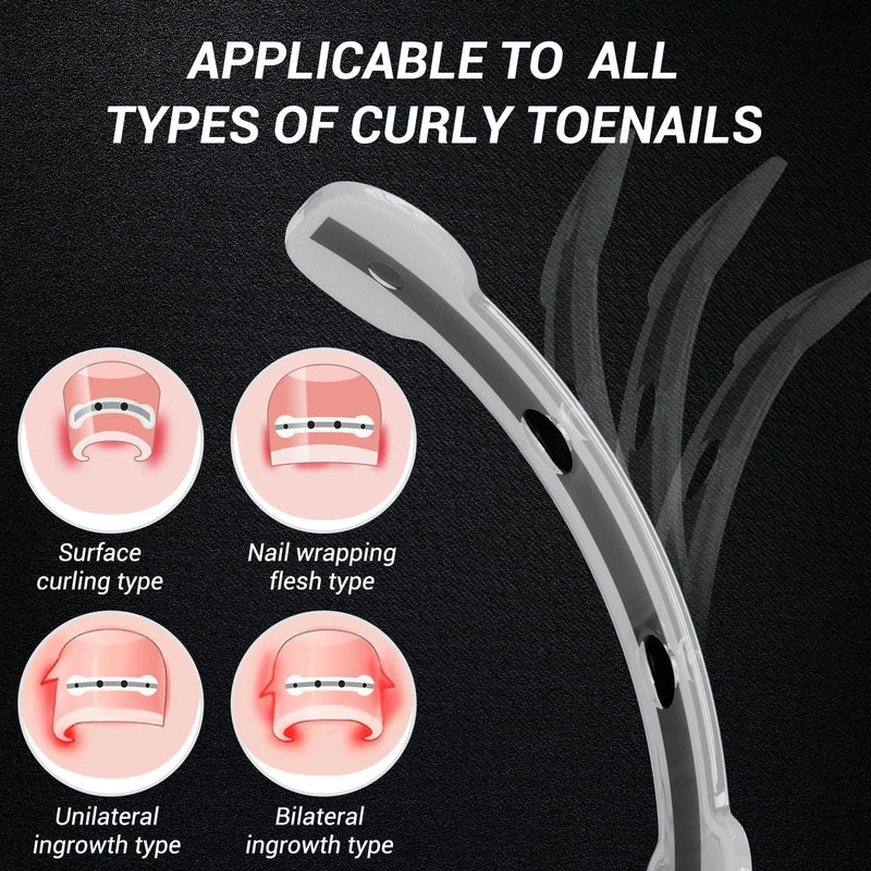 Titanium Alloy Ingrown Toenail Corrector & Pain Relief Aid - Specially Designed Ingrown Toenail & Corrector Removal Kit for Curved Nail Repair and Removal (0.59/0.67in) 0.59/0.67in