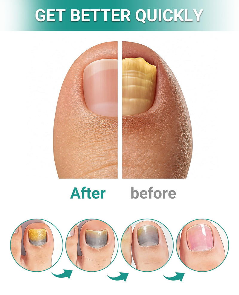 32Pcs Extra Strength Fungal Nail Patches: Upgraded Toenail Fungus Treatment Hydrogel Patches for Overnight Repair & Ingrown Toenail Care Green