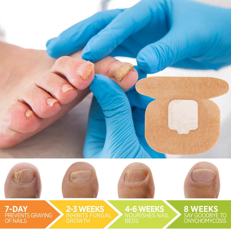 Small Nail Patches Extra Strength: 32 PCS Nighttime Hydrogel Patches for Overnight Repair - Visible Results in 8 Hours - Toenail Treatment Extra Strength - BeesActive Australia