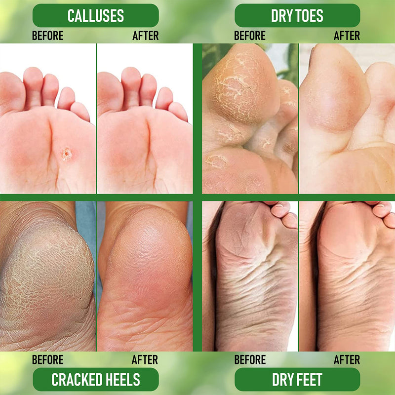 PurOrganica Urea 20% Healing Cream 4 oz - Best Callus Remover - Moisturizes and Rehydrates Hands, Feet and Knees to a Healthy Appearance - Soothes and Softens Thick, Cracked, Rough Dead and Dry Skin UREA 20% - BeesActive Australia