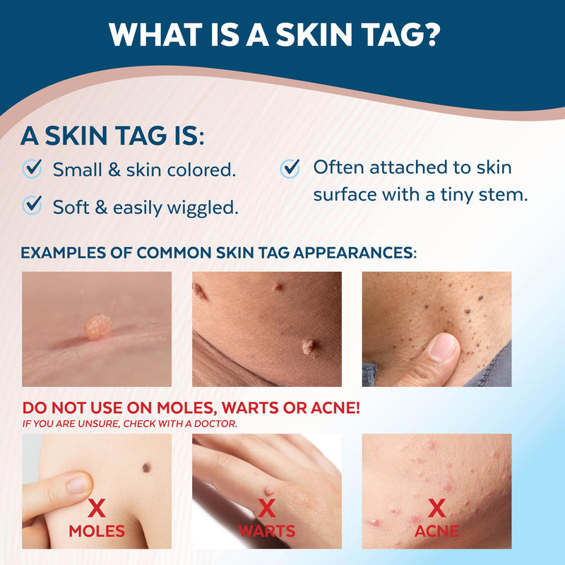 Advanced Skin Tag Remover - FDA-Cleared Device - Only for Skin Tag Removal - Works in 7-14 Days - Up to 10 Treatment Cycles - Cryogenic Freeze-Off Kit - BeesActive Australia