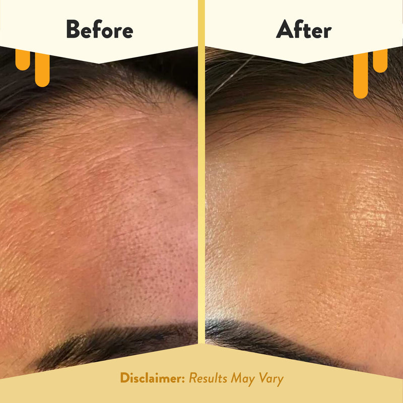 ECZEMA HONEY 15% Vitamin C + Ferulic Acid Serum, Anti Aging Skincare (1 Oz) | Face Oil for Eczema, Dry & Sensitive Skin
