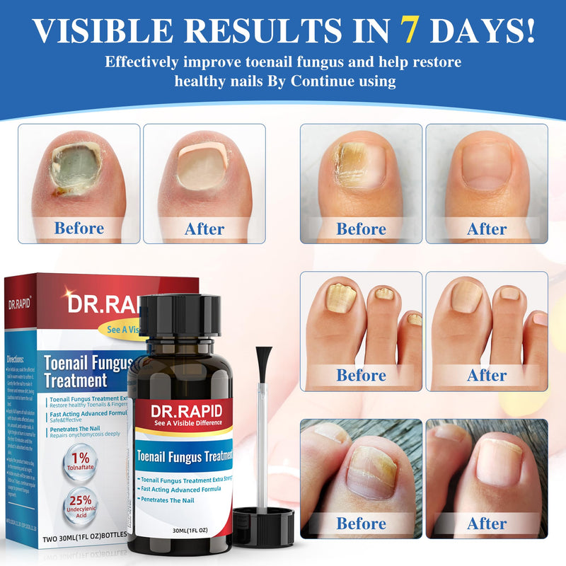 Toenail Fungus Treatment Extra Strength - Effective Antifungal Nail Repair Solution with Tea Tree Oil for Toenail & Nail Fungus, Fast Acting Treatment for Damaged Nails & Ingrown Toenail - 30ml/1fl oz 1 Fl Oz (Pack of 1) - BeesActive Australia