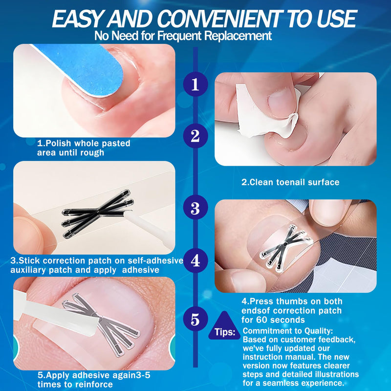 Ingrown Toenail Treatment with Upgraded 6-Angle Shape,Titanium Alloy Ingrown Toenail Corrector for Quick Relief,At-Home Ingrown Toenail Removal Kit for Toenail Curled Corrector,9Pcs