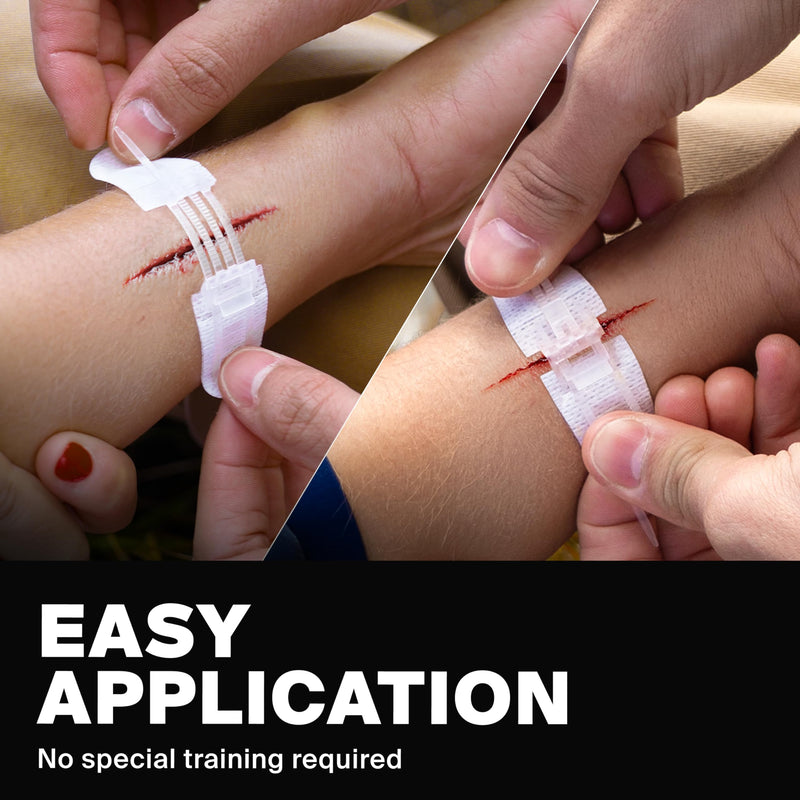 SurviveX Zip Stitch Wound Closure Kit - No Stitches Needed