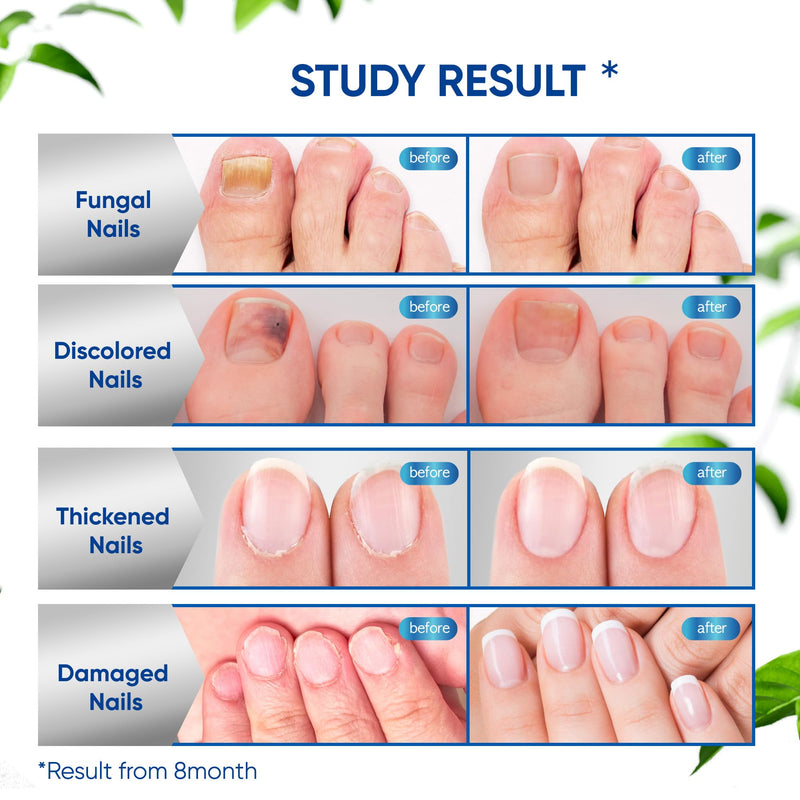 Fungus Treatment for Toenails, Toe Nail Fungus Treatment Extra Strength, Toenail Fungus Treatment, Fast Acting - 2 Packs, Black Scent 0.5 Fl Oz (Pack of 2)