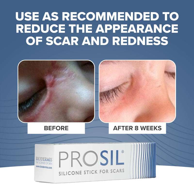 PROSIL Silicone Scar Stick 4.25 g – Medical Grade Silicone Scar Treatment for New & Old Scars – Mess Free, Glide On Scar Therapy Stick for Face & Body – Compact, Travel-Friendly Scar Care for Adults 4.25g