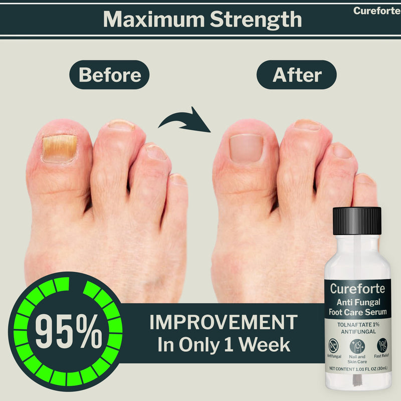 Anti-Fungal Foot & Finger Nails Fungus Treatment Maximum Strength Serum with Tolnaftate 1% – Fast Absorbing Athlete’s Foot & Fungal Skin Relief Solution – Non-Greasy Formula (30 mL) - BeesActive Australia