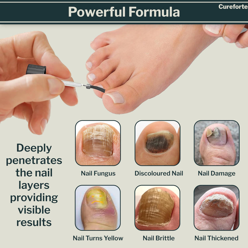 Anti-Fungal Foot & Finger Nails Fungus Treatment Maximum Strength Serum with Tolnaftate 1% – Fast Absorbing Athlete’s Foot & Fungal Skin Relief Solution – Non-Greasy Formula (30 mL) - BeesActive Australia