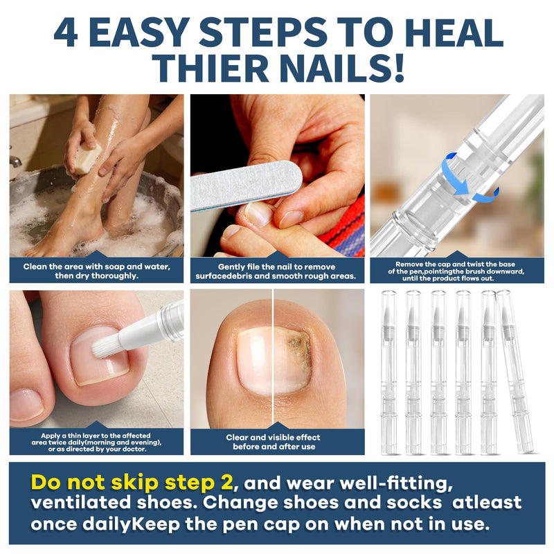FSA Eligible HSA Extra Strength Athlete‘s Foot & Toenail Fungus Treatment Pen, Toenail Treatment Pen with 25% Undecylenic Acid, Precision Applicator for Itch Relief & Nail Car - 3 Pack/6 Pack (3 Pack) - BeesActive Australia
