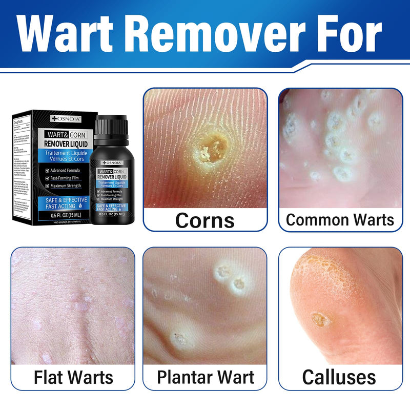 Wart Remover Liquid ‚Äì Fast Acting Salicylic Acid 17% Treatment for Plantar, Common and Flat Warts, Corn & Callus Removal ‚Äì 15ml Bottle