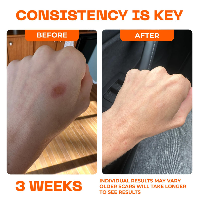 Motivo Scar Serum - Silicone Scar Treatment for New Surgical Scars, Burns, Procedures & Acne Scars - Helps Itching and Irritation for Kids & Adults - Helps Flatten & Soften Scars (10ml) - BeesActive Australia