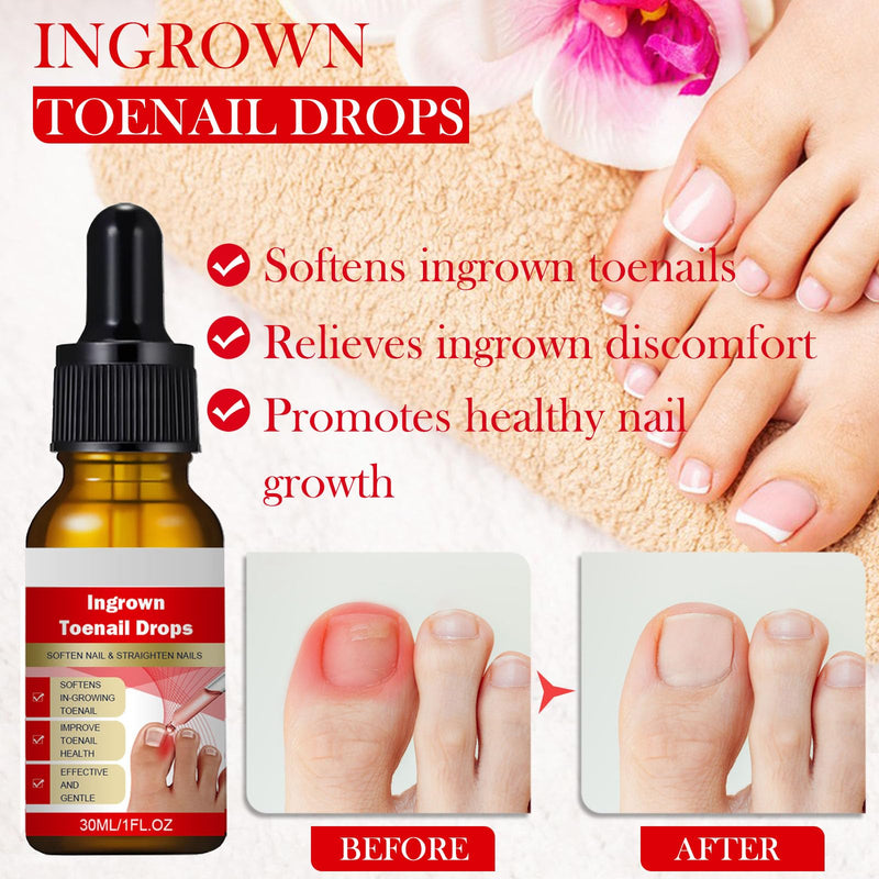 Ingrown Toenail Removal Kit, Professional Ingrown Toenail Treatment, Ingrown Toenail Tools Kit with Ingrown Toenail Corrector Drops, Toenail Clipper, Corrector Patch, Stainless Steel Pedicure Tool Set - BeesActive Australia