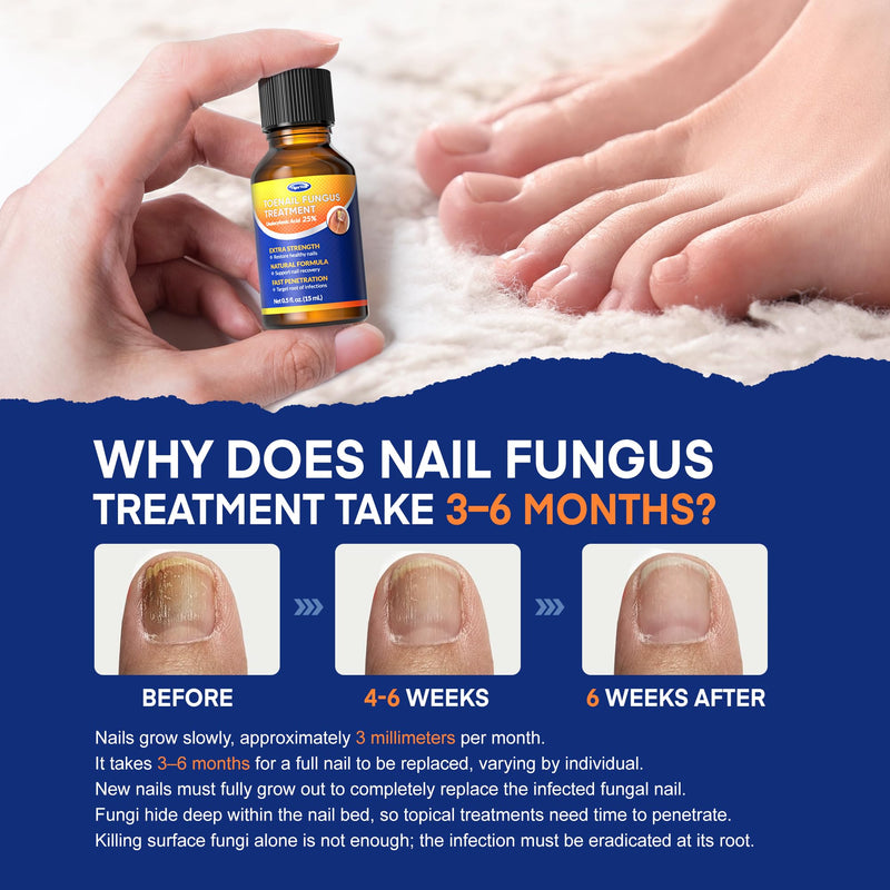 Toenail Fungus Treatment with 25% Undecylenic Acid: Toenail Fungus Treatment Extra Strength for Thick, Yellow and Damaged Nails - Safe and Gentle for Nails Care - BeesActive Australia