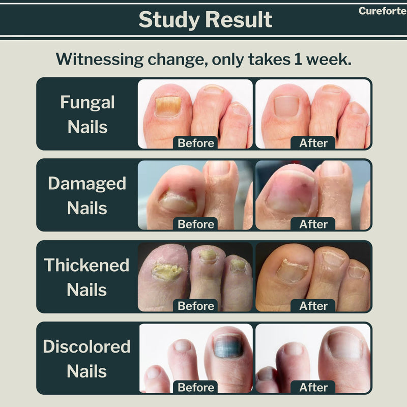 Anti-Fungal Foot & Finger Nails Fungus Treatment Maximum Strength Serum with Tolnaftate 1% – Fast Absorbing Athlete’s Foot & Fungal Skin Relief Solution – Non-Greasy Formula (30 mL) - BeesActive Australia