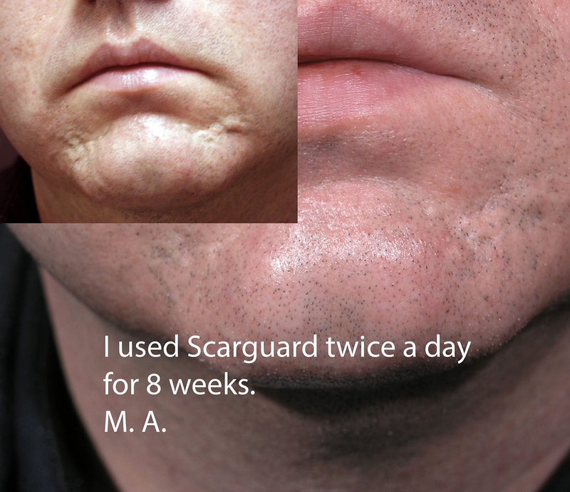 Scarguard - Invisible Brush-On Silicone Sheet with Vitamin E - Scar Removal for Keloids, Burn Scars, Surgery Scars, Stitches, Cuts - No Ugly Scar Sheets, Cream or Messy Scar Gel Needed - BeesActive Australia