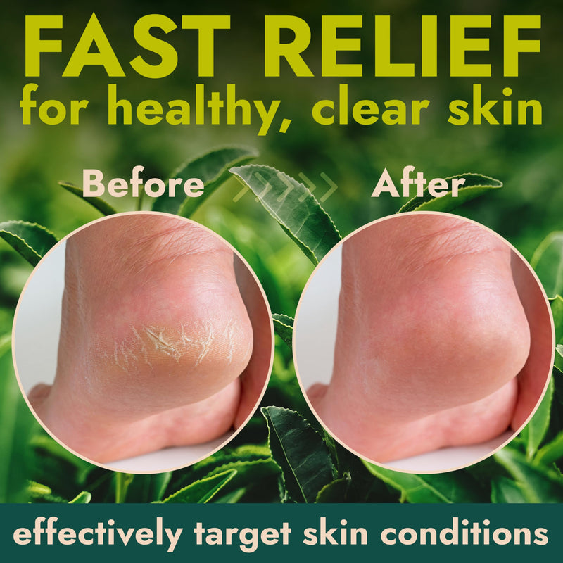 Callus Remover for Feet | Extra Strength Callus Remover Gel for Feet with Tea Tree Oil | Professional-Grade Pedicure Treatment | 50 Applications per Bottle, Includes 3 Pumice Stones | 14 fl oz - BeesActive Australia