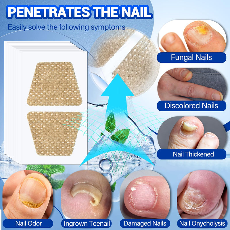 Toenail Fungus Treatment - 50Pcs Fungal Nail Patches Extra Strength with Hydrogel for Overnight Repair Nail Fungus Patches, Not Easy to Fall Off Toenail Corrector Patch 50 Count (Pack of 1)