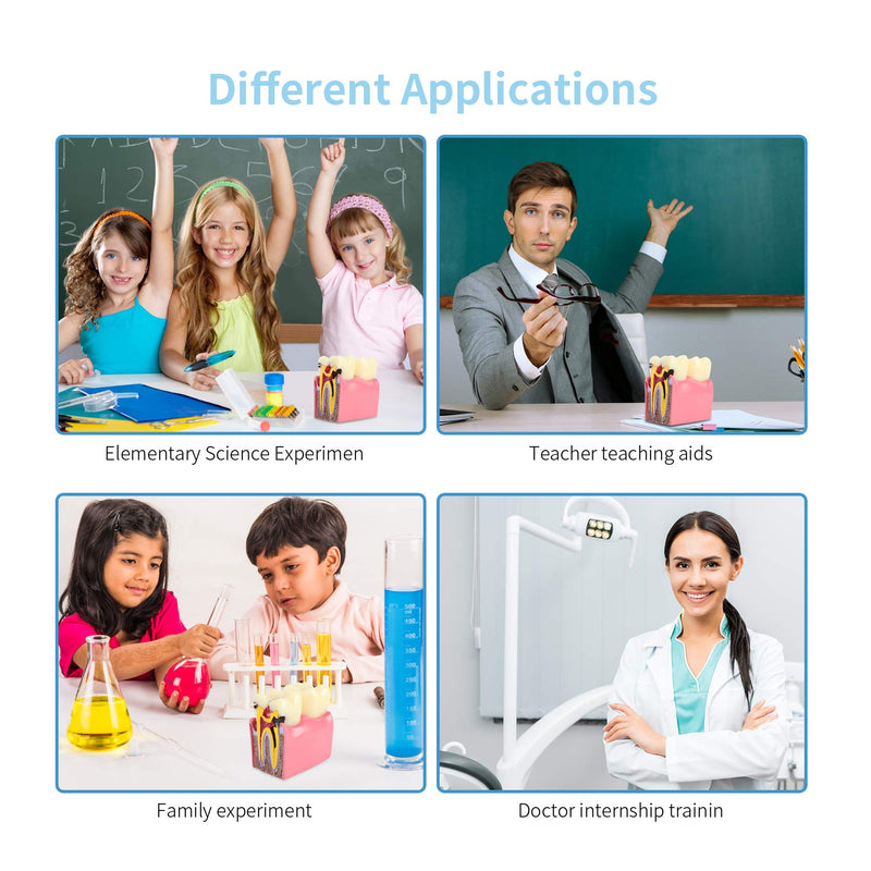 Dental Caries Tooth Model 6 Times Decay Teeth Comparative Study Model, Caries Bilateral Comparison Pathology Teeth Model Teaching Learning Tools for Dentist, Patient Education and Explanation - BeesActive Australia