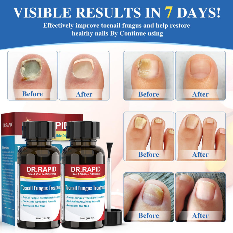 Toenail Fungus Treatment Extra Strength - Effective Antifungal Nail Repair Solution with Tea Tree Oil for Toenail & Nail Fungus, Fast Acting Treatment for Damaged Nails & Ingrown Toenail - 60ml/2fl oz 1 Fl Oz (Pack of 2)